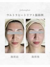 エステサロン JJシャンハイ/ウルトラヒートリフト施術例