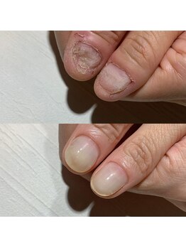 アティックネイルアトリエ(attic nail atelier)/深爪・トラブル爪改善コース