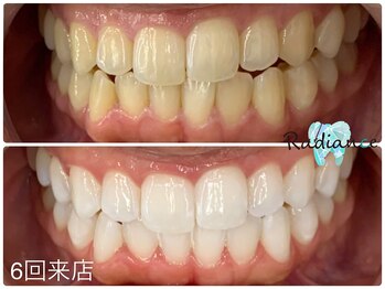 札幌セルフホワイトニング ラディアンス(Radiance)/セルフホワイトニング 