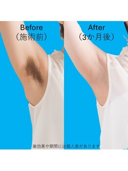 ブロッサム(BLOSSOM)/ワキ脱毛