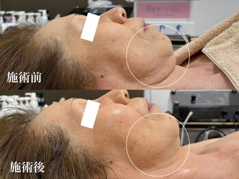 キーオブフェイス(Key of Face)/お悩み【2重顎】