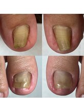 ランランネイル(rangrang nail)/どんな巻き爪も変われます！