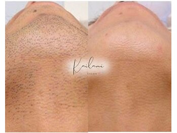 カイラニ サロン(Kai lanl salon)/ひげ
