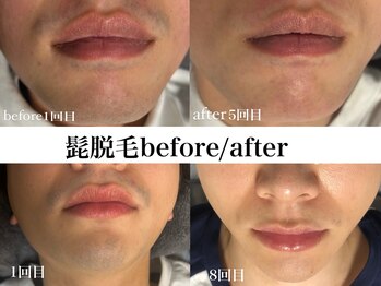 ディオン ケアナ 博多店(Dion)/ヒゲ脱毛ビフォーアフター