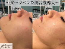 ベル 横浜(Belle)の雰囲気（【お得な回数券も】ダーマ/ハーブピーリングでニキビ毛穴ケア）