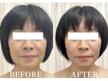 ドクターボディ 新宿店(Dr.Body)/【エラ/たるみ　50代】