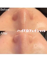 リンダ 西宮店(LINDA)/ハイドロフェイシャル