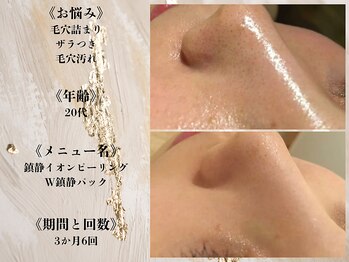 アクール(Accueil)/【毛穴・黒ずみ】