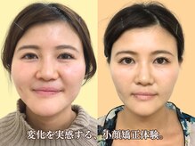 ナチュラルビューティーフェイス 横浜(NBF)/ビフォーアフター写真