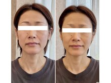 ニコワ(Nicowa)/Nicowaのコルギ★BeforeAfter