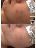 【重め悩み/倍速改善】剥離ありハーブピーリングアフター付¥35,750→¥33,000