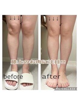 エンチャント(ENCHANT)/膝上のお肉撃退超音波リフト