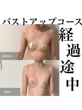 サロンツキ(salon tuki)/バストケア症例