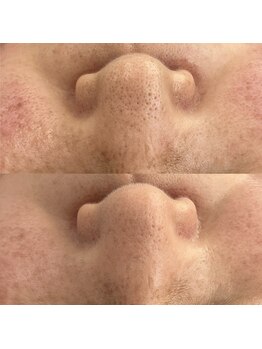 ヴェルシック(Belchic)/毛穴をキレイにして引き締める