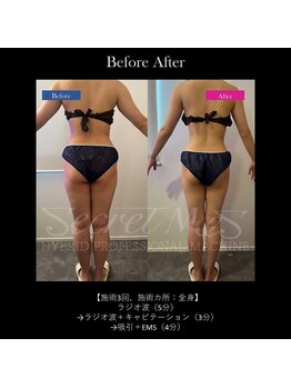 フェレザ 新潟(Felleza)/新潟-痩身エステ-BODYエステ