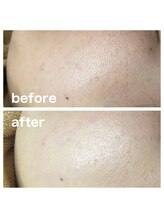 ミレボ 川内店(Me.rebo)/クリスタルパック