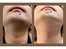 エール(AeLL)/☆ルミクス脱毛☆