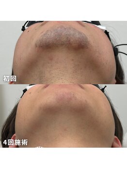 ビビ(BB)/20歳の大学生のヒゲ脱毛