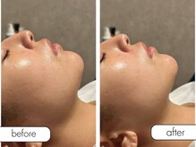 エステルーム ココ(COCO)/ミコステラ施術後