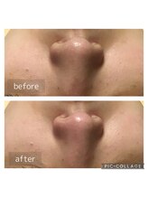 トータルビューティサロン リボーテ(Re:Beaute)/毛穴レスリフト