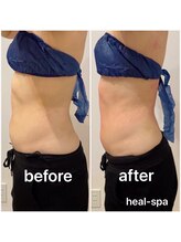ヒール スパ(heal spa)/Before &nbsp;After