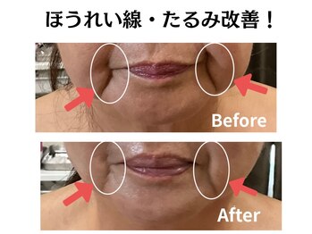 グレースティー 森町 箕面/ほうれい線・たるみリフトアップ