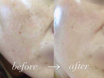 ラ ルーナ 本町(La Luna)/ハーブピーリング!オススメ★