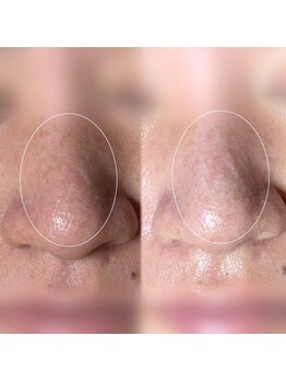 ソワ 吉塚店(soi)/毛穴につまった白いプツプツ汚れ