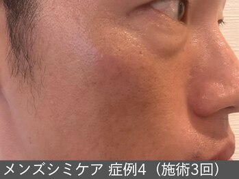 オアシスラグーン(OASIS LAGOON)/メンズシミケア(症例4施術3回)