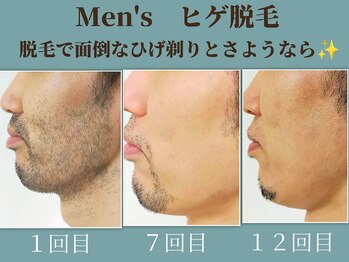 ラーナ(Lana)/ヒゲ脱毛　before→after