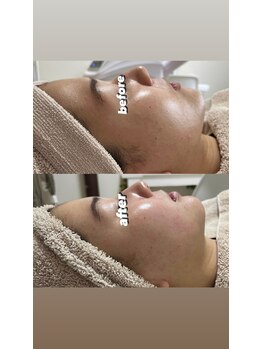 ミ ジュエル(me jewel)/ハーブピーリングのビフォアフ