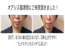 整体院オアシス イオンモール福津店(OASIS)/小顔ビフォーアフター