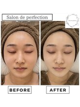 サロン ド パーフェクション(Salon de Perfection)/小顔リフト