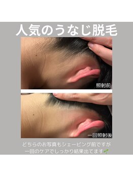 シェノン(Chainon)/脱毛