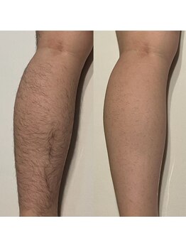 バーベナ/毛穴レス美肌脱毛で全身清潔感UP