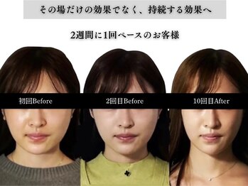 アロエベル(aloe Belle)/Before After（10回施術）