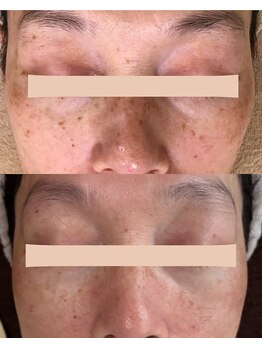 サロンドミュウ(Salon de Mieux)/【シミ】でお悩みのお客様