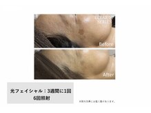 モイ(Moi’e)/シミ・たるみ