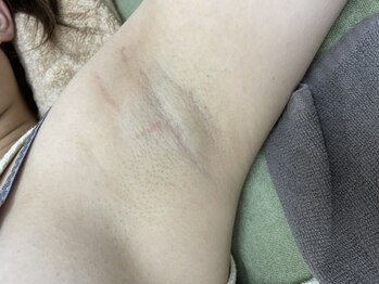 ナノハナ/鹿沼市全身脱毛美容室ナノハナ