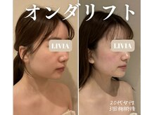 リビア(LIVIA)の雰囲気（最新マシン・オンダリフト☆痛みやダウンタイムなくリフトアップ）