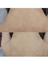 アンティクイーン(Antiqueen)/最中　大きなニキビケア！