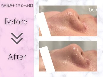 リライフ(ReLIFE)/韓国肌管理/毛穴洗浄+ララピール