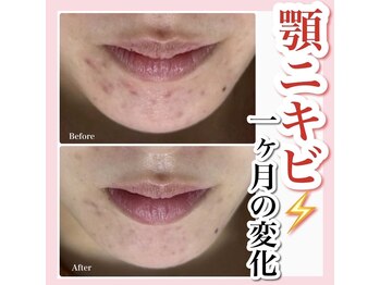 ホワイトアクア 天王寺本店(WHITE AQUA)/ハーブピーリング/大阪/天王寺