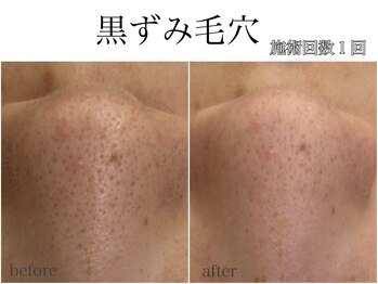 ラフェリ(Rafeli)/毛穴悩み