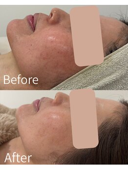 シーズ ザ デイ 熊本店(Seize the day)/赤みOFF、艶肌ララピール☆