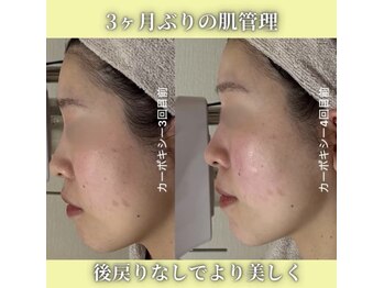 ハニエル(Haniel)/カーボキシー症例