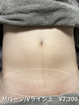 カナウ(KANAU)/【Mパーツ/脱毛】Vライン上