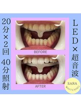 ココティ ホワイトニング(Cocotii)/ビフォーアフター