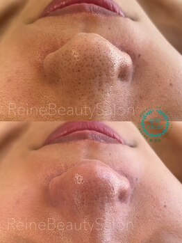 レーヌ(Reine)/毛穴エクストラクション