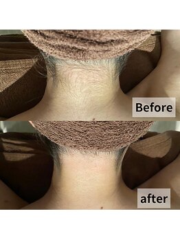 セイリキ(SEIRIKI)/うなじ脱毛